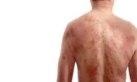 درباره سندرم درس (DRESS) چه می دانید؟/ از ایجاد تا درمان