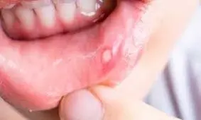 علل بروز آفت دهان و روش‌های درمان آن