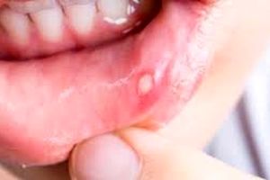 علل بروز آفت دهان و روش‌های درمان آن