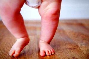چرا کودکان دچار پای پرانتزی می شوند؟