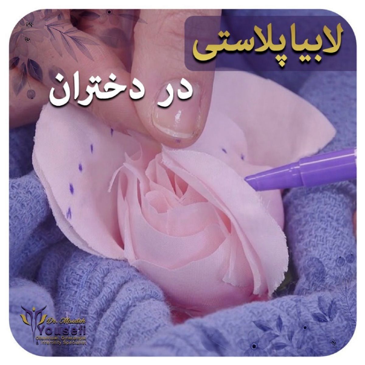  لابیاپلاستی در دختران مجرد