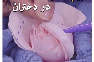  لابیاپلاستی در دختران مجرد