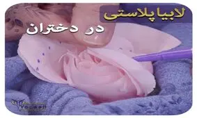  لابیاپلاستی در دختران مجرد