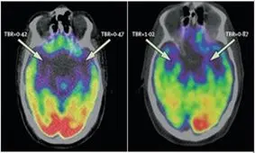 قسمتی از مغز که عامل استرس و حمله قلبی است
