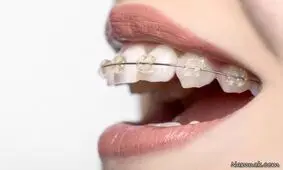 چرا باید ارتودنسی کنیم؟