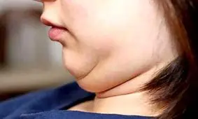 چربی اضافه گردن و اطراف چانه را فوری برطرف کنید!