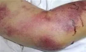هر آنچه باید درباره «تب کریمه کنگو» بدانید