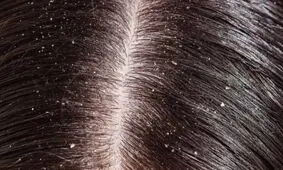 شوره ی سر ناشی از چیست؟
