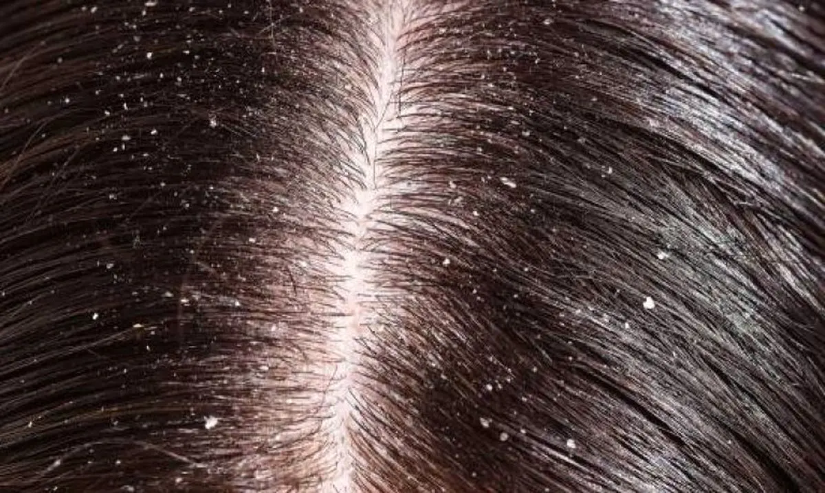 شوره ی سر ناشی از چیست؟