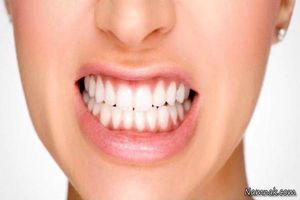 دندان قروچه چه بلایی بر سر دندانهای شما می آورد؟