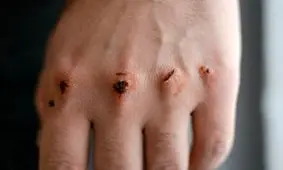 نقش حیاتی یک پروتئین در سرعت ترمیم زخم‌