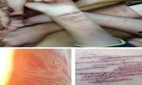 «خون‌بازی» پدیده عجیب مدارس دخترانه