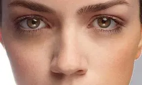 پنج راه‌ حل برای رفع تیرگی اطراف چشم