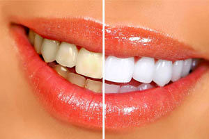 زردی دندان از چیست؟