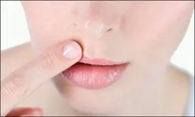 سریعترین درمانهای گیاهی تبخال لب