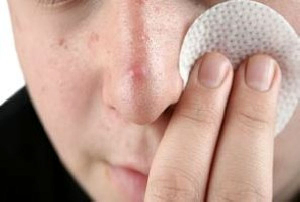 آیا جوشهای سرسیاه بینی شمارا آزار میدهد؟