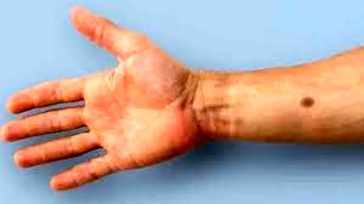 تشخیص زودهنگام سرطان پوست با آزمایش خون