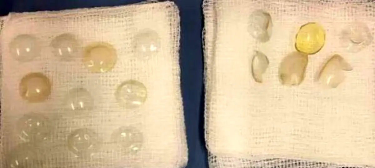 خارج کردن 27 لنز از چشم این خانم