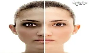 از لکه های سیاه پوستتان رنج می برید؟