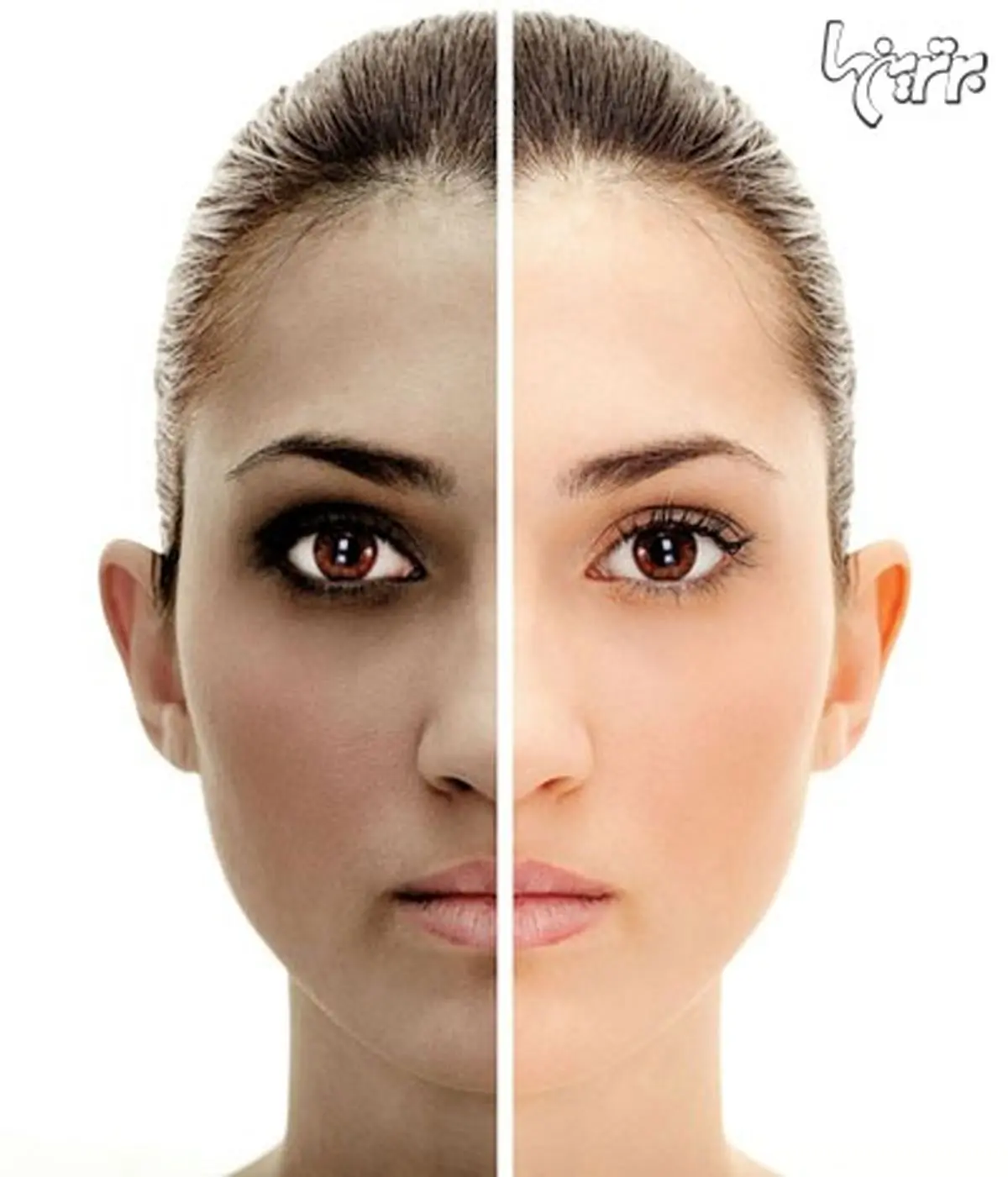 از لکه های سیاه پوستتان رنج می برید؟