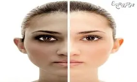 از لکه های سیاه پوستتان رنج می برید؟
