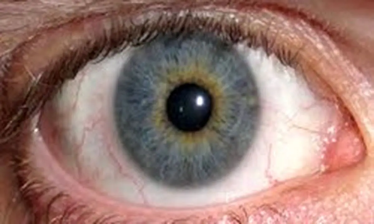 علائم و راه‌های درمان «آب سیاه»