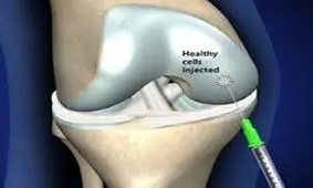 پیوند مفاصل آسیب دیده با سلول‌های بنیادی