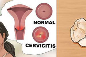 روش استفاده از سیر در واژن زنان برای درمان عفونت