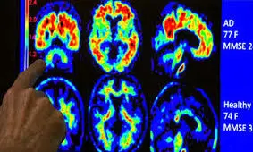 درمان آلزایمر با امواج مافوق صوت