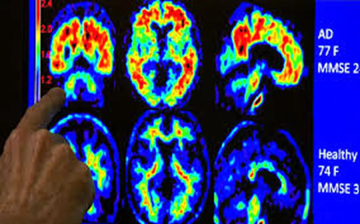 درمان آلزایمر با امواج مافوق صوت