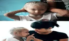 پسری با پوست تن پولکی عجیب مانند ماهی