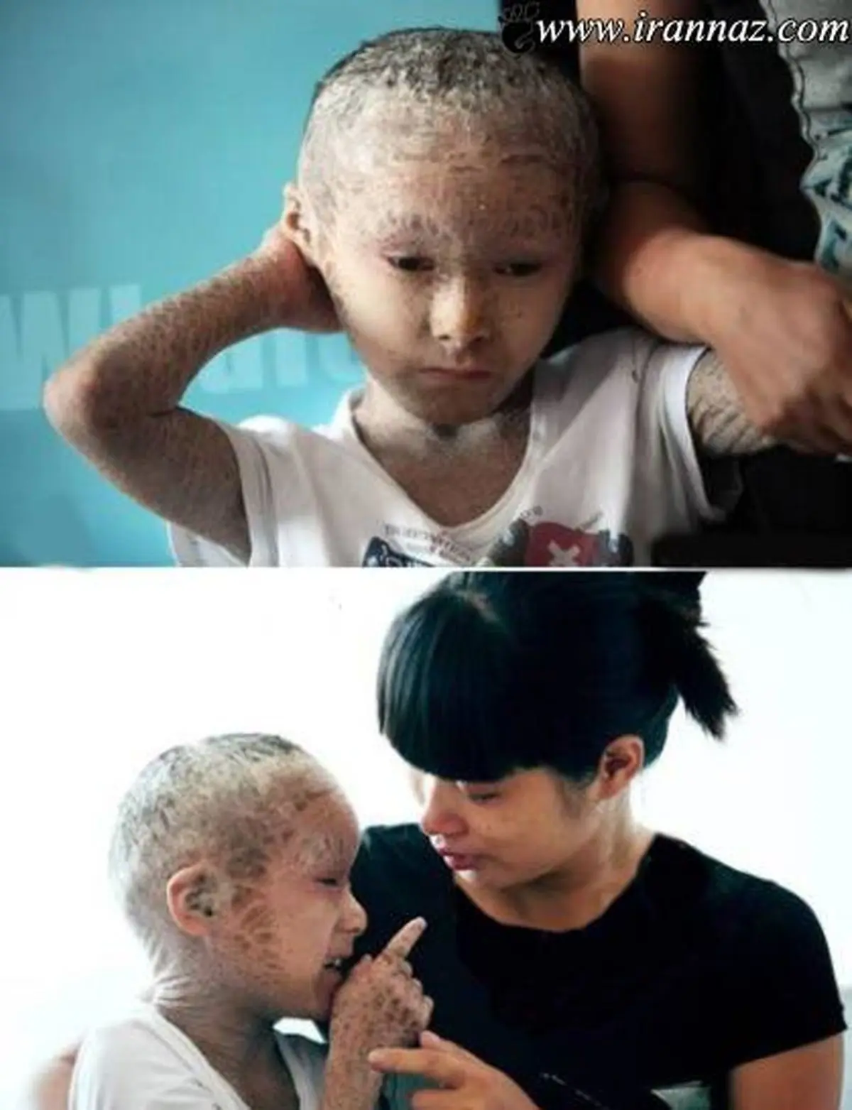 پسری با پوست تن پولکی عجیب مانند ماهی