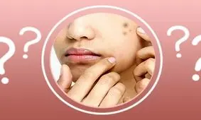 ( جوش صورت ) شما به دلیل استفاده از این وسیله است!!