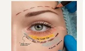 عمل بلفاروپلاستی و هر آنچه باید قبل و بعد بلفاروپلاستی بدانید