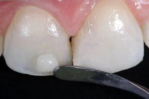 بهترین و ارزان‌ترین گزینه برای ترمیم و زیبایی دندان‌ها چیست؟
