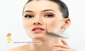 درمان جوش های زیر پوستی در خانه