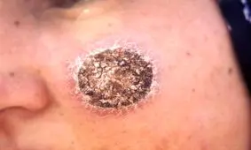 هشدار شیوع برخی بیماری های پوستی در کشور