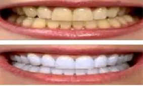 زردی دندان ها را چگونه برطرف کنیم ؟