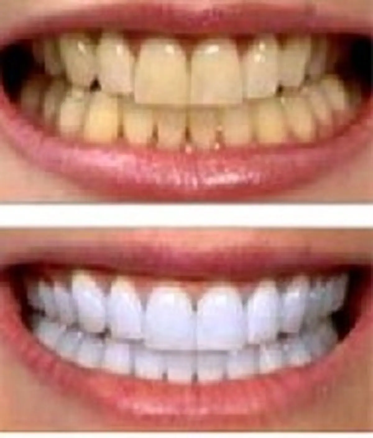 زردی دندان ها را چگونه برطرف کنیم ؟