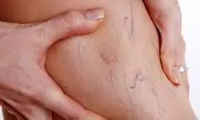 چطور دچار واریس نشویم؟