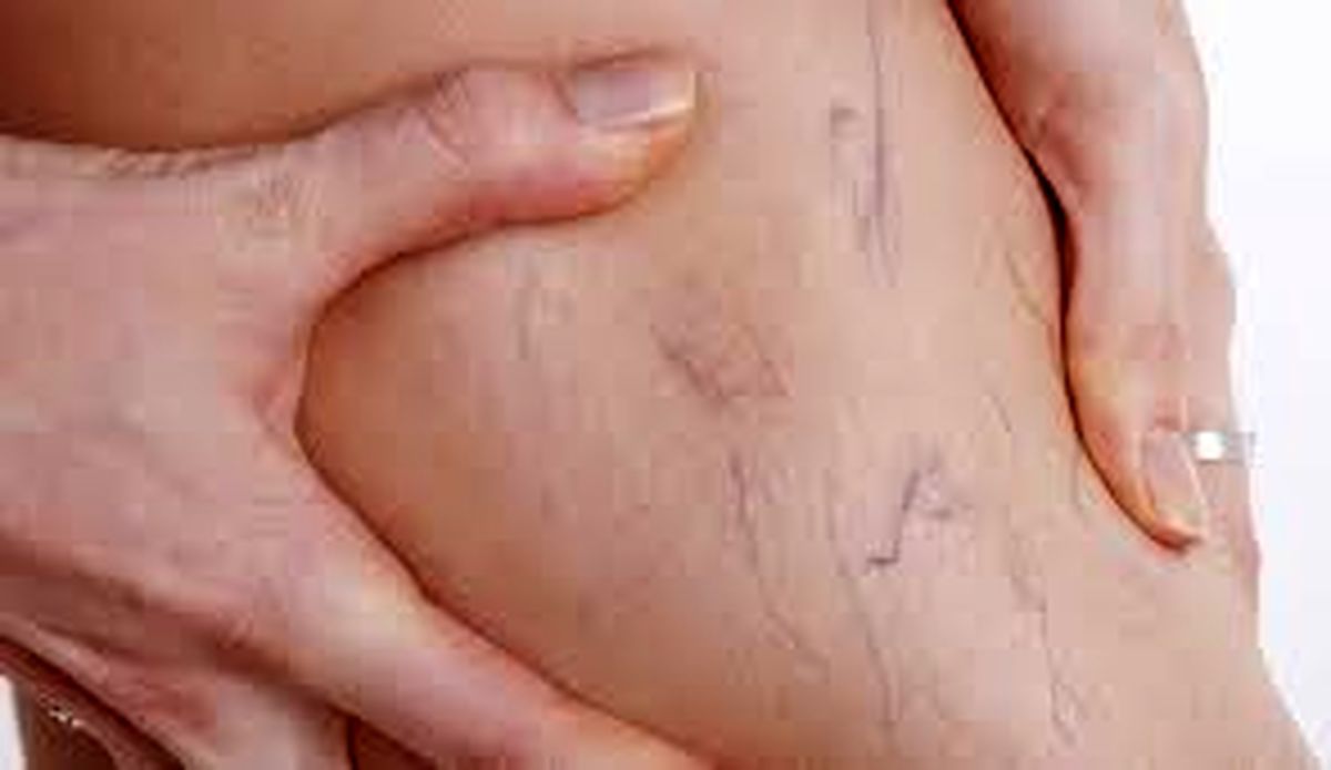 چطور دچار واریس نشویم؟