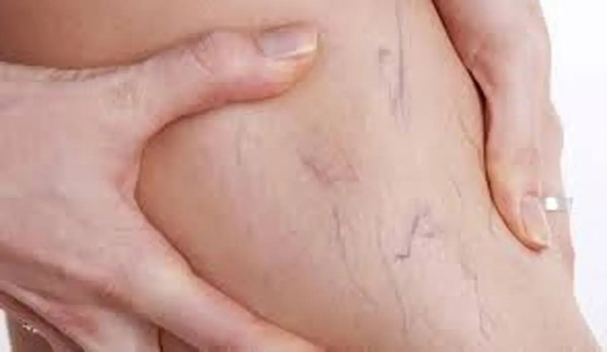 چطور دچار واریس نشویم؟