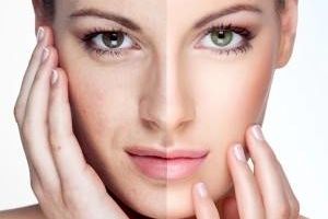 چگونه لکه های سیاه پوستی را از بین ببریم؟