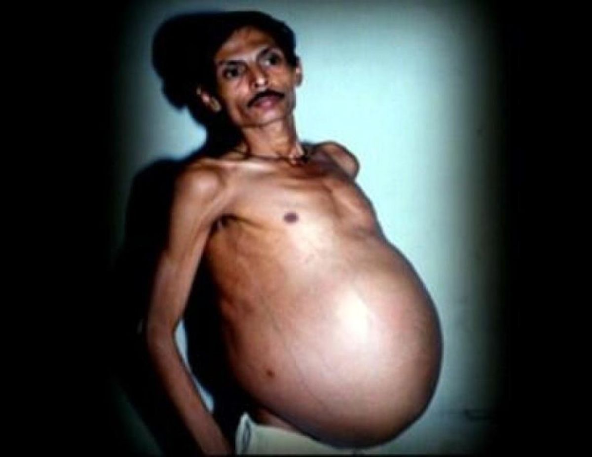 این مرد بعد از 36 سال بچه در شکم خود را درآورد