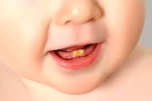 جلوگیری از سیاه شدن دندان کودک با قطره آهن