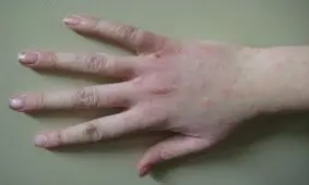 آنچه درباره اگزما باید بدانید