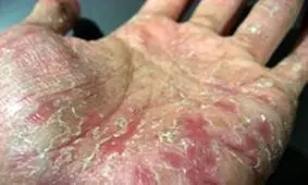 آنچه در مورد درمان اگزما باید بدانید