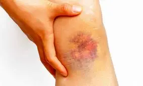 وقتی علت کبودی بدن شما نگران کننده است