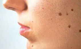 چه خال‌هایی باید حتما بررسی شوند؟