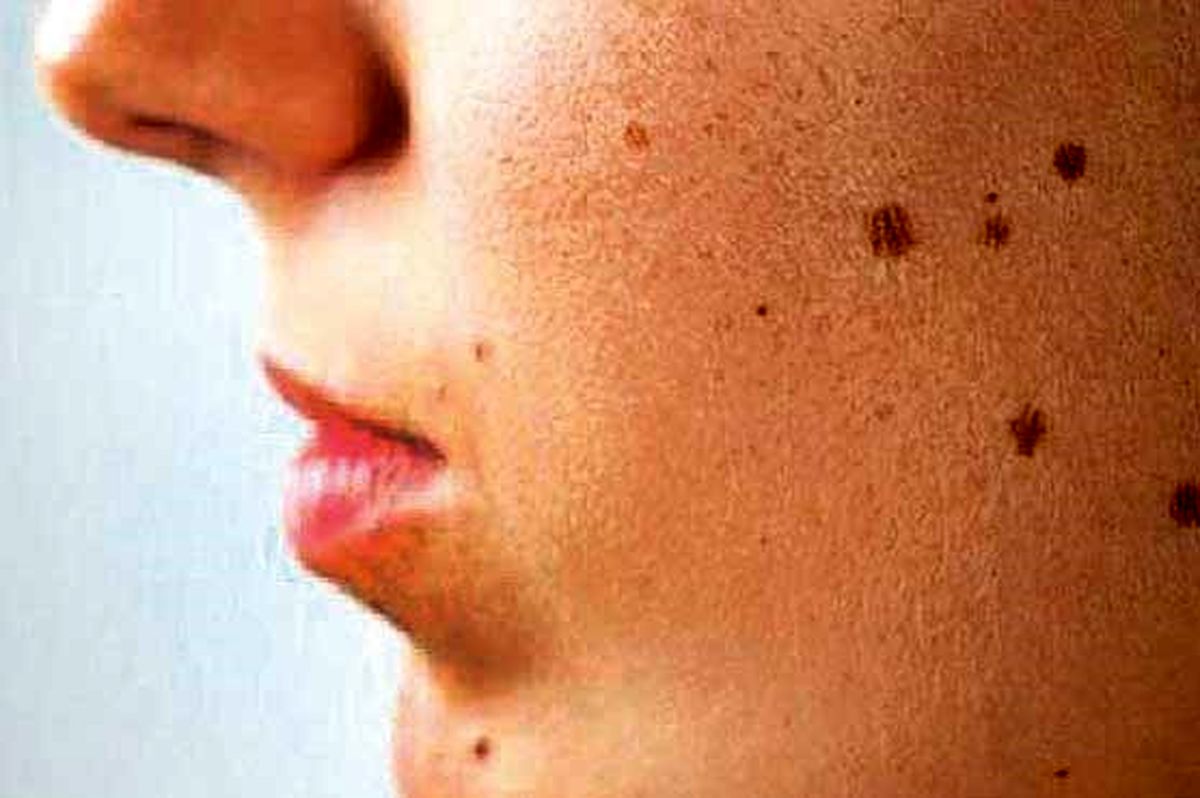 چه خالهایی باید حتما بررسی شوند؟